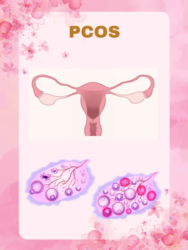 Getting Pregnant with PCOS: A 6 Step Complete Guide